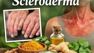 Natural Remedies for Scleroderma