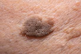 Seborrheic Keratosis