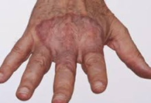 Managing Granuloma Annulare Stress for Better Skin Recovery