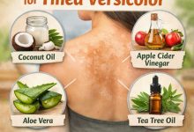 Natural Home Remedies for Tinea Versicolor