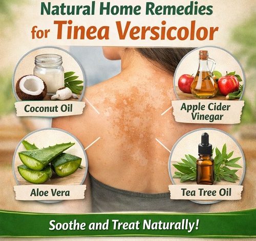Natural Home Remedies for Tinea Versicolor