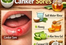 Natural Remedies for Canker Sores