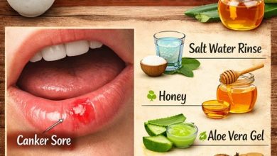 Natural Remedies for Canker Sores