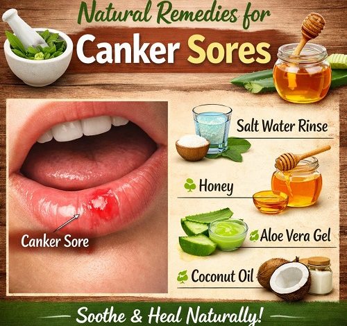 Natural Remedies for Canker Sores