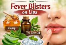 Natural Remedies for Fever Blisters on Lips