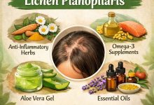 Natural Remedies for Lichen Planopilaris