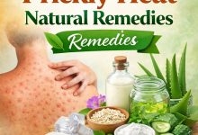Prickly Heat Natural Remedies