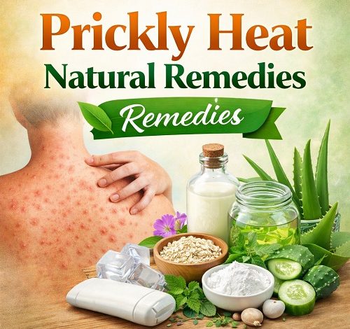 Prickly Heat Natural Remedies