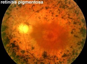 Retinitis Pigmentosa