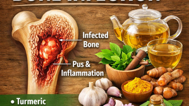 Herbal Remedies for Bone Infection