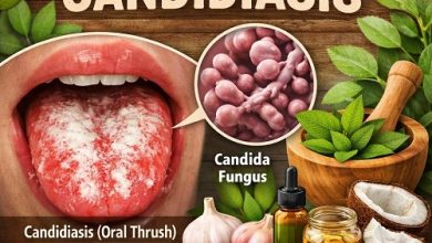 Herbal Remedies for Candidiasis