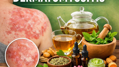 Herbal Remedies for Dermatomyositis
