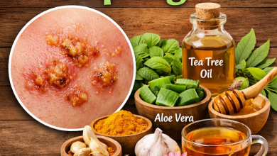 Herbal Remedies for Impetigo