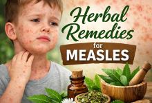 Herbal Remedies for Measles