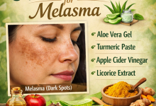Herbal Remedies for Melasma