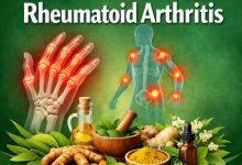 Herbal Remedies for Rheumatoid Arthritis