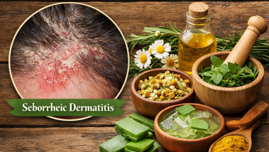 Herbal Remedies for Seborrheic Dermatitis
