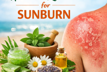 Herbal Remedies for Sunburn