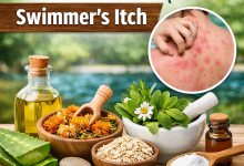 Herbal Remedies for Swimmer’s Itch