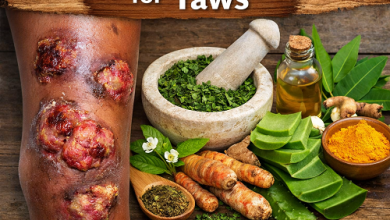 Herbal Remedies for Yaws