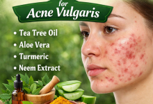 Herbal Remedies for Acne Vulgaris