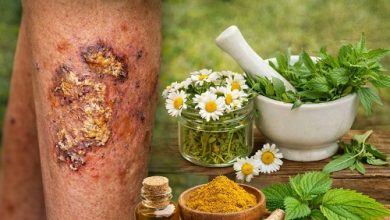 Herbal Remedies for Ecthyma