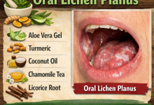 Herbal Remedies for Oral Lichen Planus