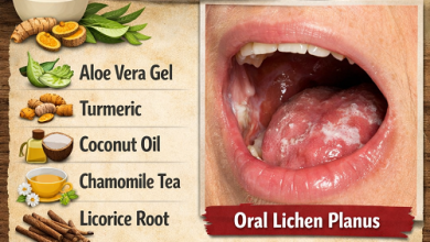 Herbal Remedies for Oral Lichen Planus