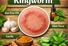 Herbal Remedies for Ringworm