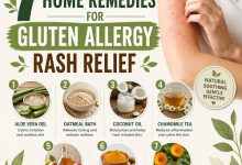 7 Effective Home Remedies for Gluten Allergy Rash Relief