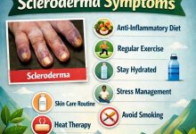 7 Natural Ways to Manage Scleroderma Symptoms