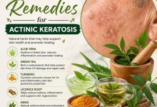 Herbal Remedies for Actinic Keratosis