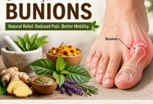 Herbal Remedies for Bunions
