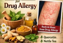 Herbal Remedies for Drug Allergy