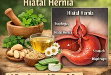 Herbal Remedies for Hiatal Hernia