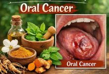 Herbal Remedies for Oral Cancer