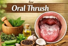 Herbal Remedies for Oral Thrush