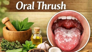 Herbal Remedies for Oral Thrush
