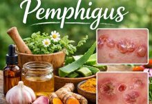 Herbal Remedies for Pemphigus