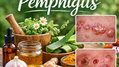 Herbal Remedies for Pemphigus