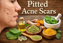 Herbal Remedies for Pitted Acne Scars