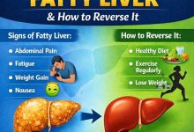 what are the signs of fatty liver and how to reverse it