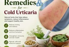 Herbal Remedies for Cold Urticaria